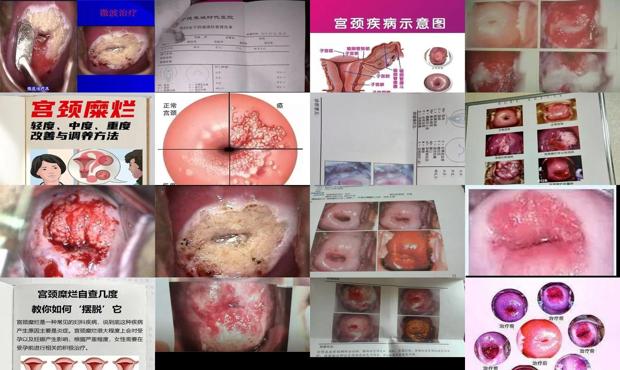 汕头宫颈糜烂的症状