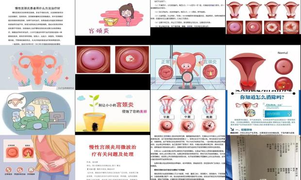 汕头治疗宫颈炎
