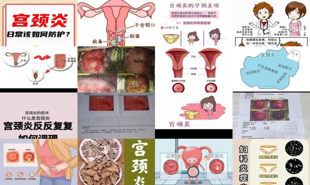 汕头宫颈炎怎么造成的