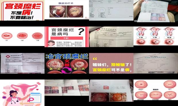 汕头宫颈糜烂怎样治
