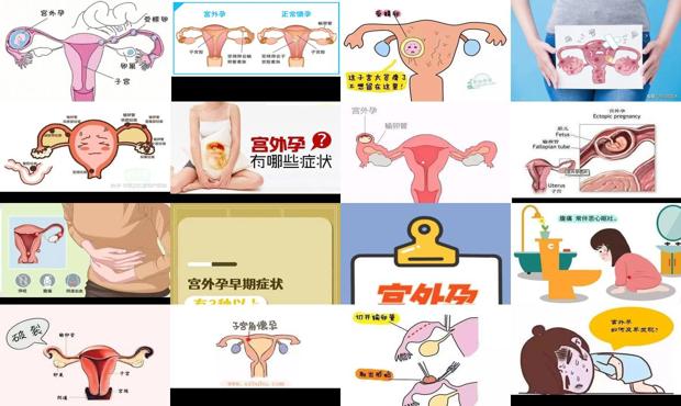 汕头宫外孕症状