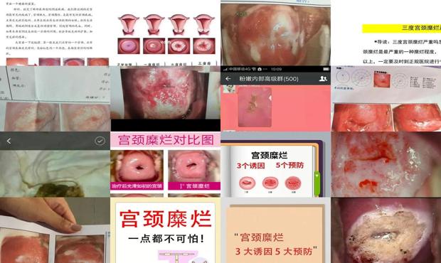 汕头宫颈糜烂三度严重吗