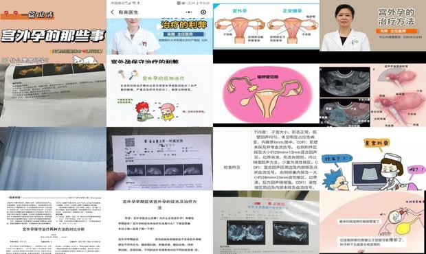 汕头宫外孕怎么治疗