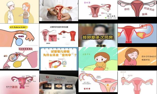 汕头怎样会得宫外孕