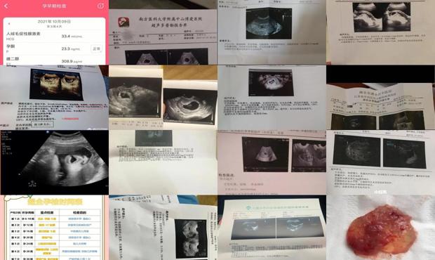 汕头怀孕35天排除宫外孕