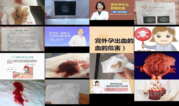 汕头宫外孕多久会出血