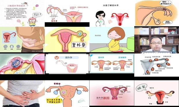 汕头宫外孕有什么症状