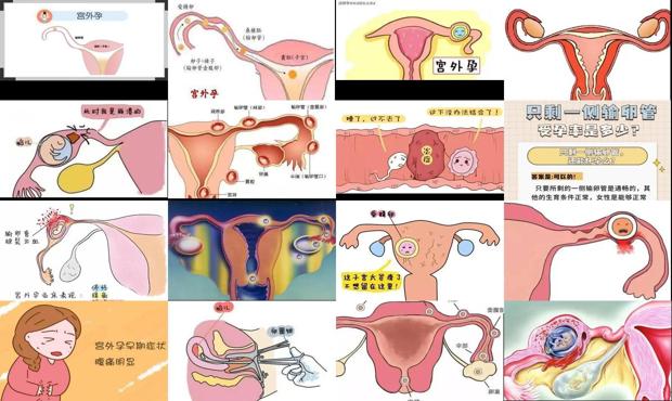 汕头宫外孕是怎么造成的