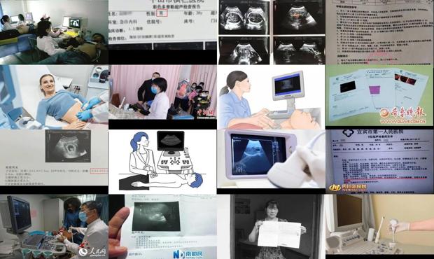 汕头腹部b超能检查出什么
