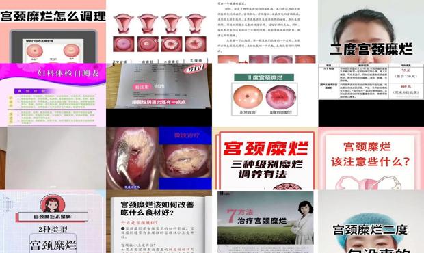 汕头宫颈糜烂二度怎么治疗