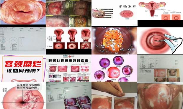 汕头怎么会得宫颈糜烂