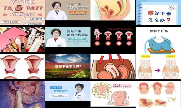 汕头宫颈下垂怎么办