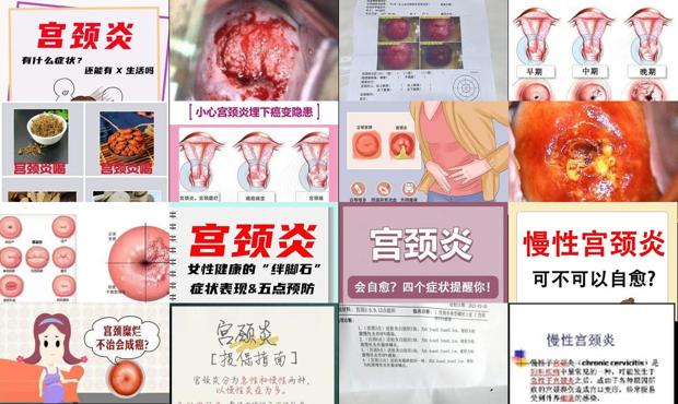 汕头慢性宫颈炎能自愈吗