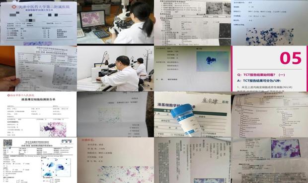 汕头液基细胞学检查