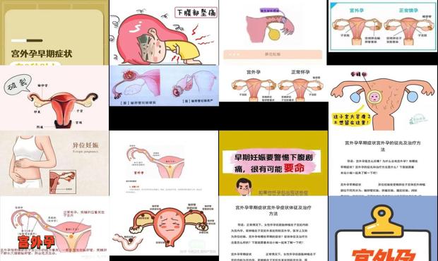 汕头宫外孕早期有啥症状