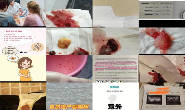 自然流产去医院要多少钱 - 汕头自然流产的症状