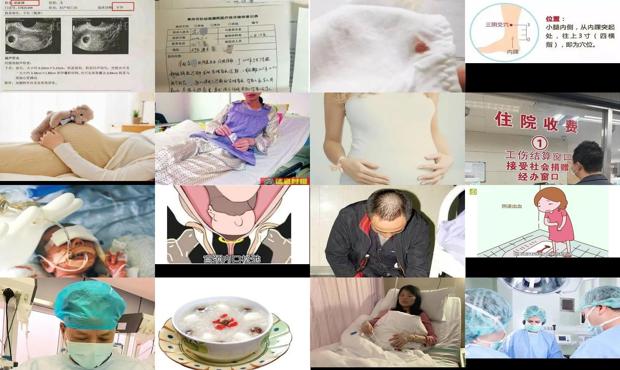 汕头怀孕1个月流产