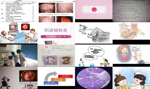 汕头阴倒镜检查的费用