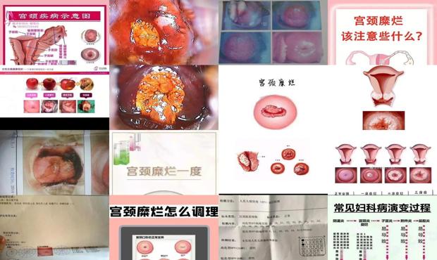 汕头一度宫颈糜烂的表现