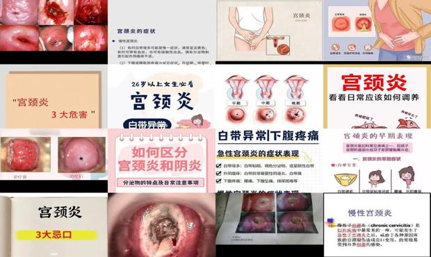 汕头宫颈炎都有什么症状