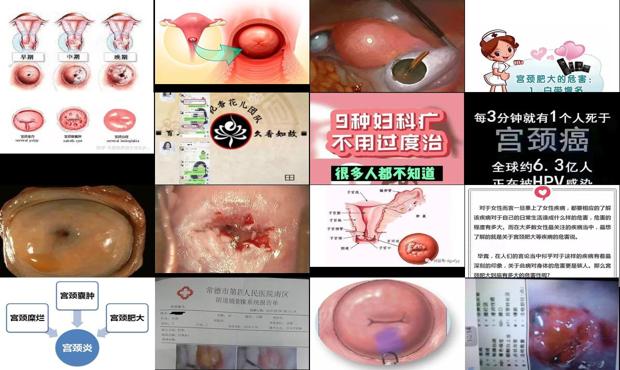 汕头宫颈肥大有什么危害