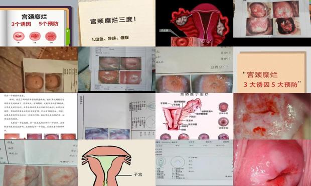 汕头宫颈糜烂3度怎么回事