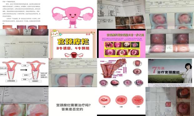 汕头宫颈糜烂如何治疗
