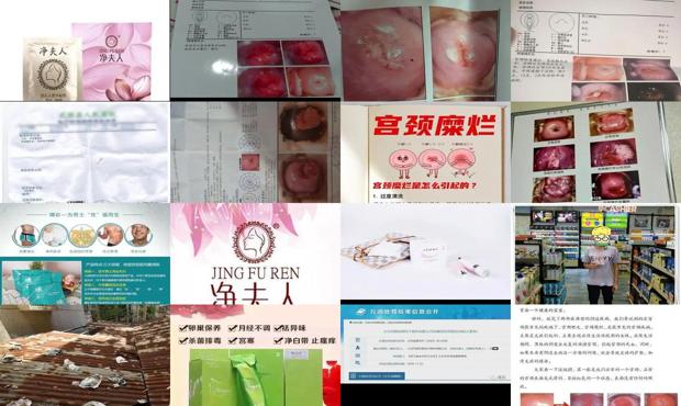 汕头中度宫颈糜烂严重吗