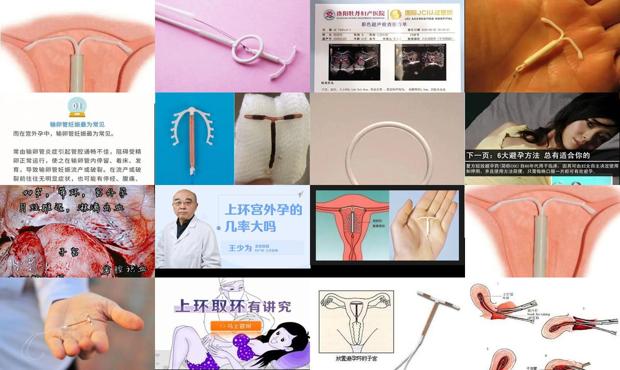 汕头上环容易宫外孕吗