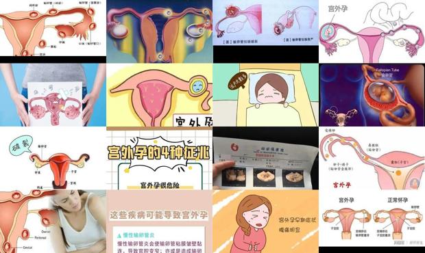 汕头为什么会宫外孕呢