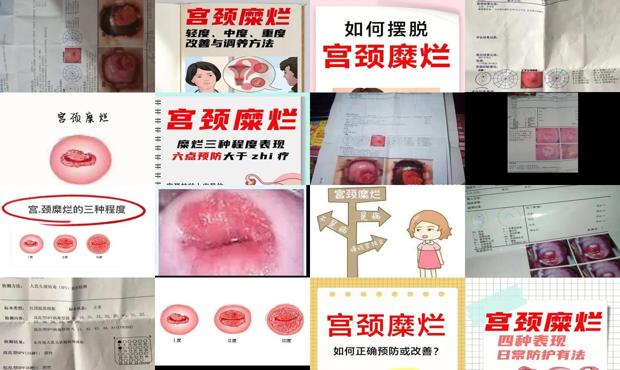 汕头中度宫颈糜烂会自愈吗