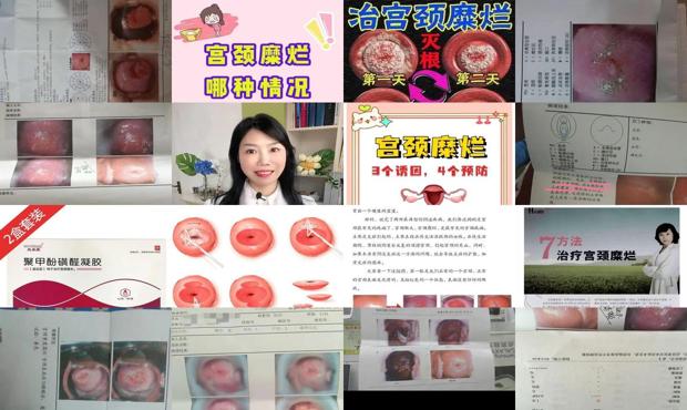 汕头宫颈糜烂治疗