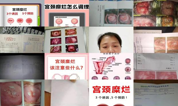 汕头宫颈糜烂2度手术费