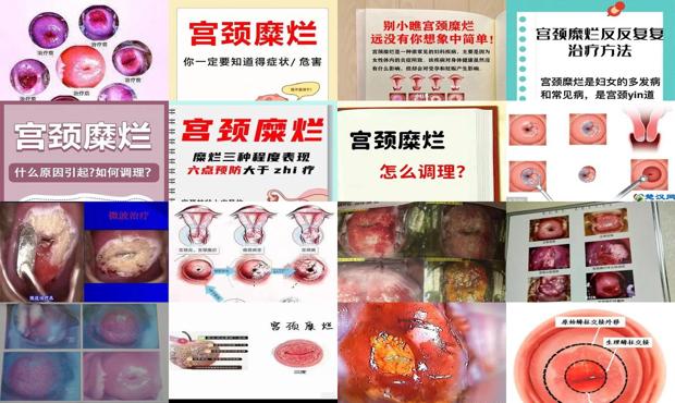 汕头宫颈糜烂什么表现