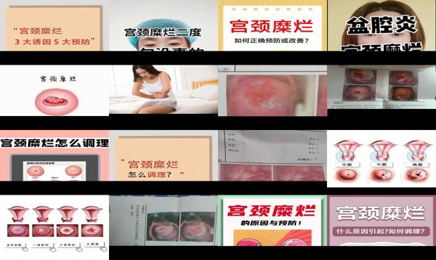 汕头宫颈糜烂二度怎么自愈