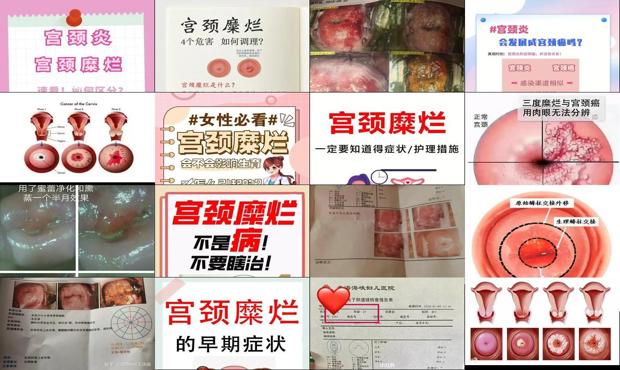 汕头宫颈炎和宫颈糜烂一样吗