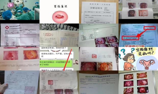 汕头宫颈糜烂手术治疗多少钱