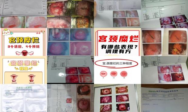 汕头宫颈糜烂中度严重吗