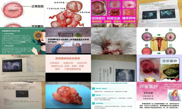 汕头妇科炎症*严重吗