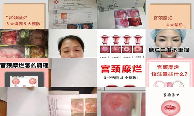 汕头宫颈糜烂2度怎样治疗