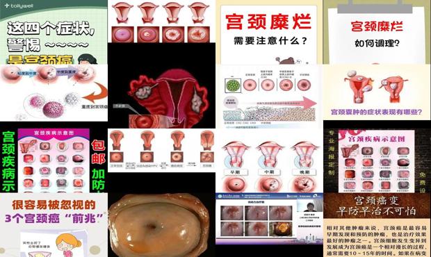 宫颈疾病有哪几种症 - 汕头宫颈疾病症状
