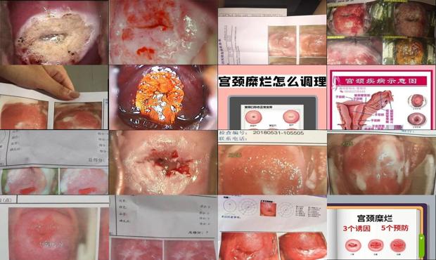 汕头宫颈糜烂一二三度图片