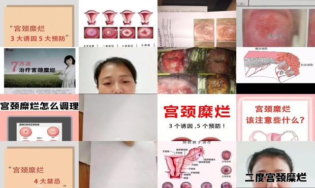 2度宫颈糜烂治疗费用一般多少钱呢 - 汕头2度宫颈糜烂怎么治疗