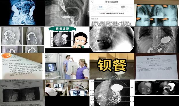 汕头钡餐检查能查出什么