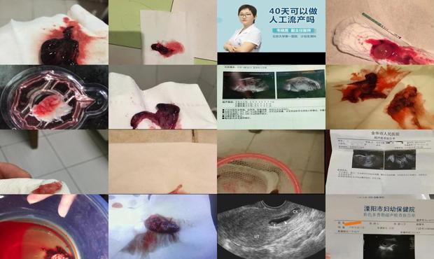 怀孕40天能分男女吗 - 汕头怀孕40天怎么流产最好