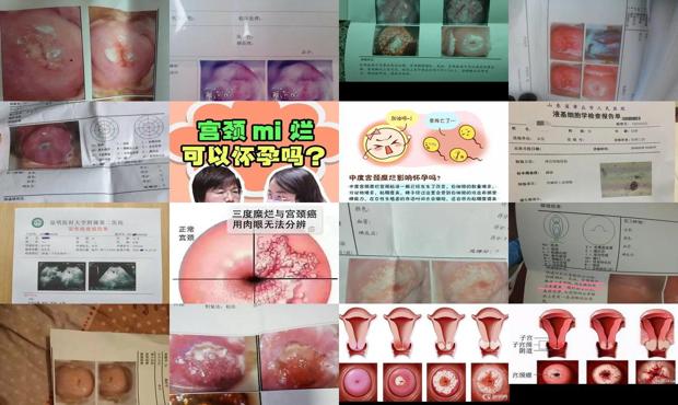 汕头宫颈糜烂能不能怀孕