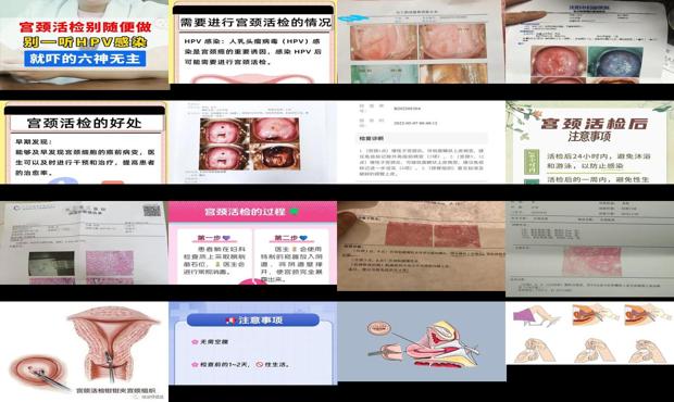 汕头做宫颈活检多少钱