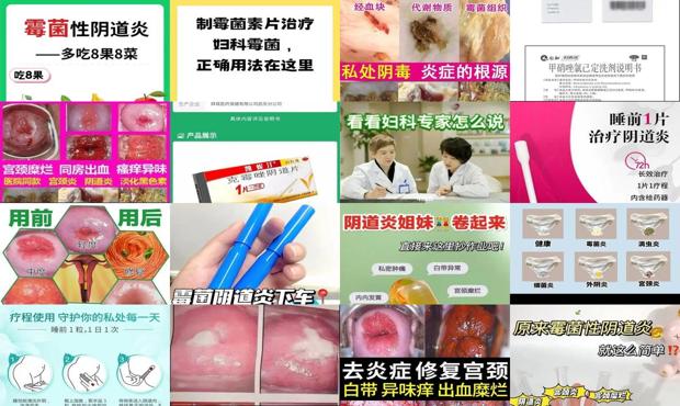 汕头妇科炎症霉菌怎么治疗