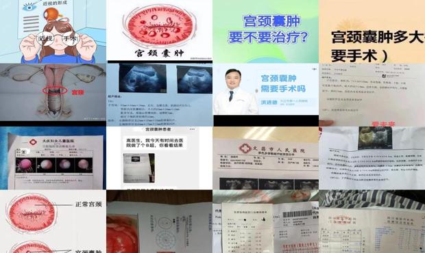 汕头宫颈*手术多少钱