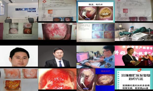 汕头微波治疗宫颈糜烂
